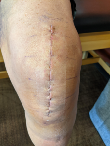 left-knee-2021-10-01-bandage-off.jpg