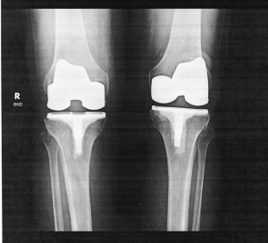 knee-right-2022-01-14-3-week-X-ray.jpg
